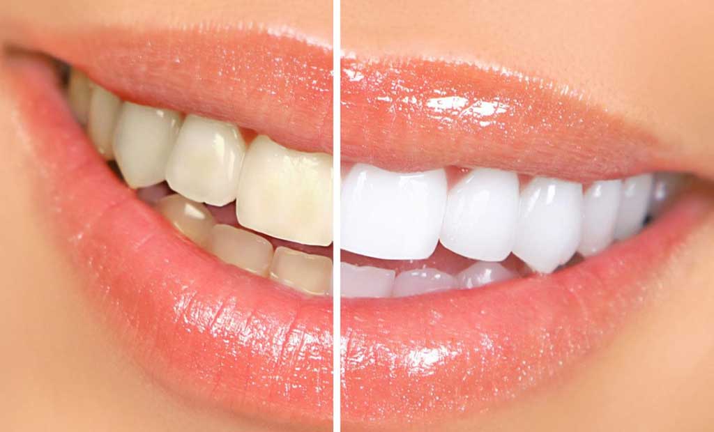 Trước và sau khi tẩy trắng răng 